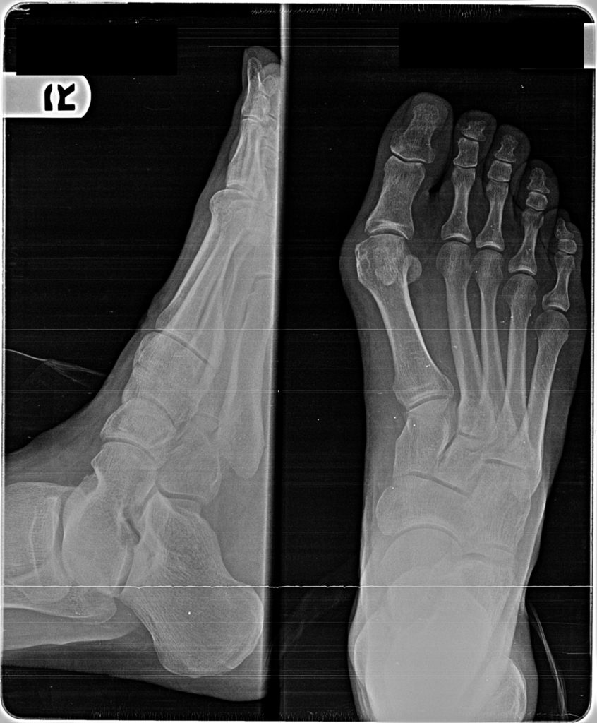 X-ray of my foot showing the bone alignment and bunion